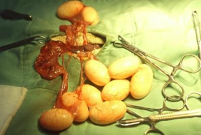 以外科方式取出。
