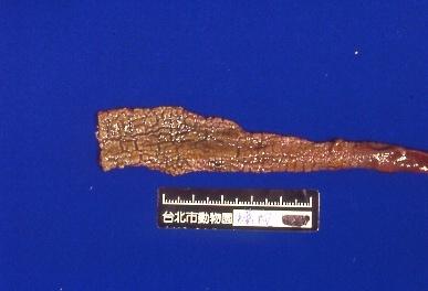 嚴重腸炎造成的偽膜